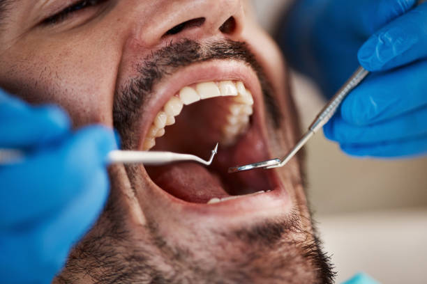 Best Emergency Wisdom Teeth Removal in Spencer, OK